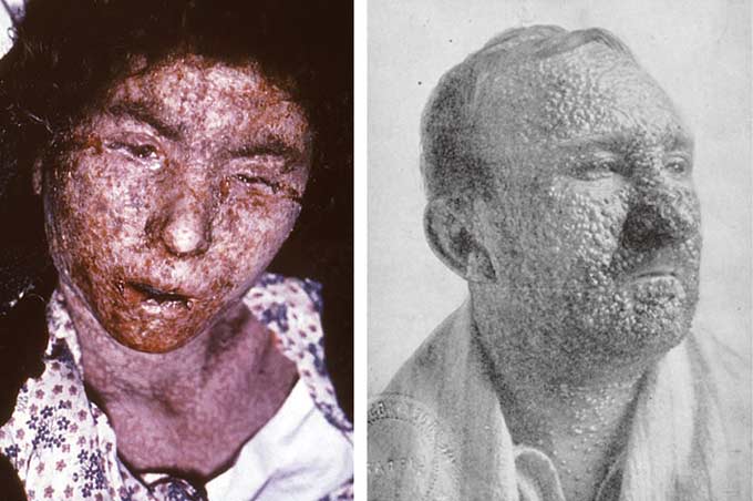 天然痘を制圧せよ ワクチン誕生物語 エドワード・ジェンナー 前編